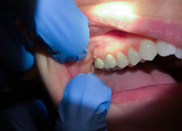 Best Emergency Tooth Extraction in Corvallis, MT