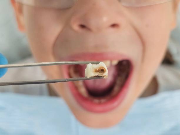 Best Emergency Wisdom Teeth Removal in Corvallis, MT
