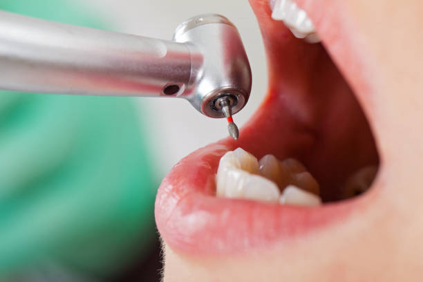 Best Emergency Tooth Extraction in Corvallis, MT